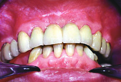 Применение стоматологических лазеров в современной стоматологии