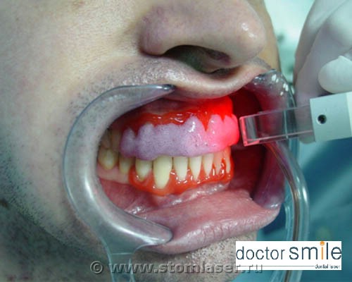 Новая система лазерного отбеливания зубов DOCTOR SMILE™ LWS Titanium -  Стоматологические лазеры и лазерная стоматология, применение лазеров в  стоматологии